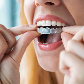 A woman placing an Invisalign tray in her mouth