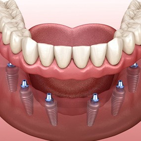 a 3D illustration of an implant denture