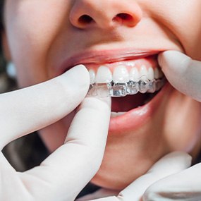 A dentist placing an Invisalign tray over a patient’s teeth