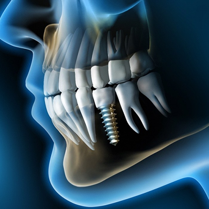 Dental Implant Bone Graft Lexington Dental Wellness Of Lexington