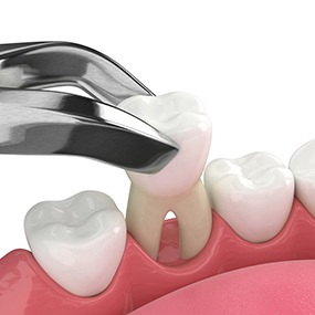 There are many factors that affect the cost of your tooth extraction, including the location of the tooth